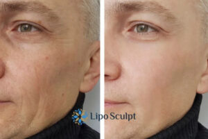How to Fight Aging Symptoms 3 Fight Aging Symptoms Edinburgh With HIFU and Morpheus8 Today!