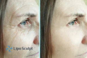 How to Fight Aging Symptoms 2 Do you want to Fight Aging Symptoms Edinburgh? Contact Lipo Sculpt today!