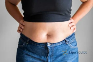 Bidding Farewell to Muffin Tops with Aqualyx Fat Injections 2 Do you wish you could reduce your muffin top Edinburgh With Aqualy fat dissolving injections you can!